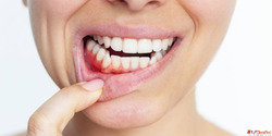 Gum Infection Treatment in Indiranagar Bangalore - House of ...