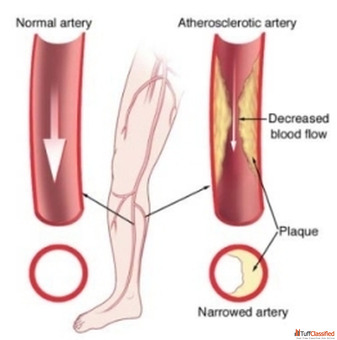 Effective Management of PAD Treatment for Better Vascular Health