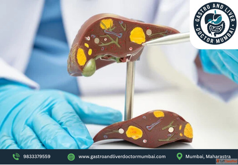 Best Liver Transplant Doctor in Mumbai for Expert Liver Surgery - Dr. Chetan Kalal