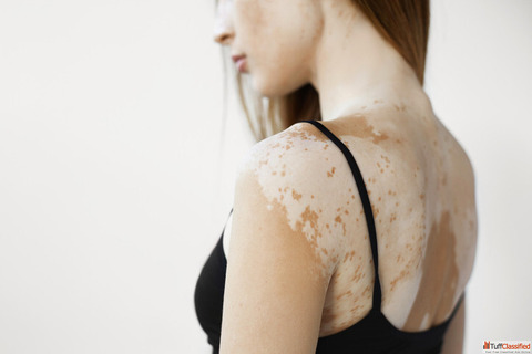 Can Vitiligo Affect the Entire Body