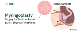 Myringoplasty Surgery for Eardrum Repair - Safe Effective Tr...