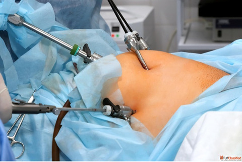 Laparoscopic Surgery Near Me - Surgical Consultation
