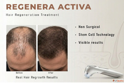Regenera Activa Hair Treatment Advanced Hair Regrowth Therap...