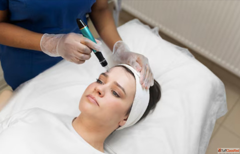Micro Needling Treatment at Dermapuritys