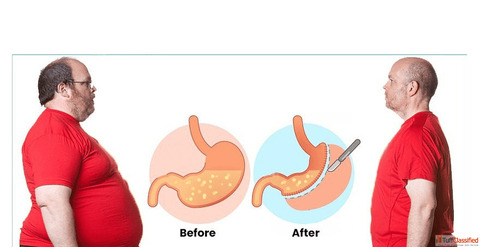 Safe Effective Bariatric Surgery in Ahmedabad at Hope Obesity Centre