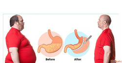 Safe Effective Bariatric Surgery in Ahmedabad at Hope Obesit...