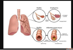 Trusted COPD Specialist in Jaipur Rajasthan - Dr. Virendra S...
