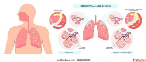 Trusted ILD Specialist in Jaipur Rajasthan - Dr. Virendra Singh