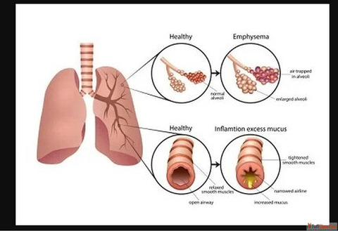Comprehensive COPD Care by Experienced Specialists in India - Asthma Bhawan