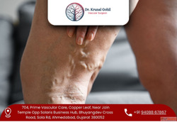 Best Varicose Veins Treatment in India by Dr. Krunal Gohil