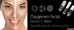 Affordable OxyGeneo Facial in Surrey Purely Pampered