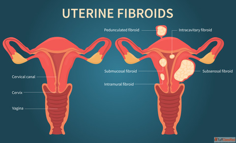 Uterine Fibroid Embolization Cost in India - Safe and Non-Surgical Treatment