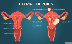 Uterine Fibroid Embolization Cost in India - Safe and Non-Su...