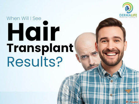 Hair Transplant in Gurgaon - Advanced FUE Hair Restoration at Dermalife Clinic