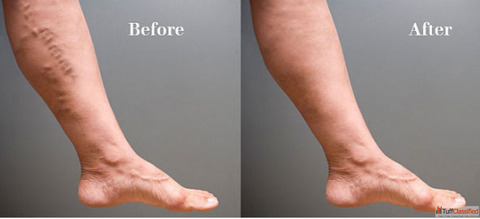 Expert Varicose Veins Specialist for Advanced and Minimally Invasive Treatment