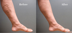 Expert Varicose Veins Specialist for Advanced and Minimally ...
