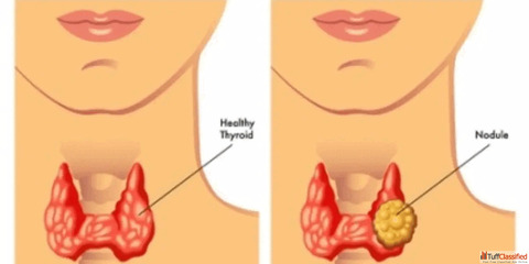 Advanced Thyroid Nodule Treatment for Better Outcomes