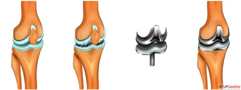 Expert Knee Replacement Surgeon in Ahmedabad