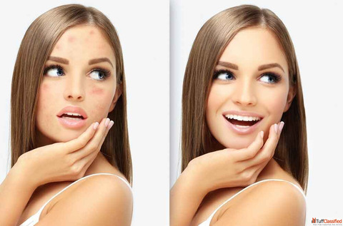 Acne vs Acne Scars Finding the Right Treatment for Clearer Skin