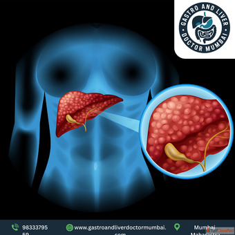 Leading Liver Transplant Doctor in Mumbai with Expert Team