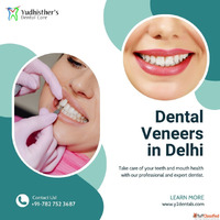 Veneers Treatment in Delhi