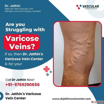 Advanced Vein Care for Healthy Circulation Lasting Comfort
