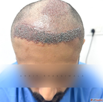 Indore Hair Transplant Advanced Hair Restoration Treatment in Indore