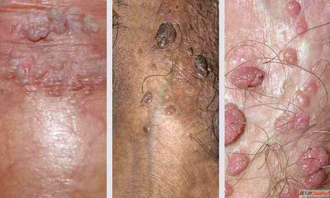 Tired of Recurring Genital Warts Try Homeopathy