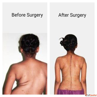 Best scoliosis doctor in Vizag