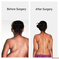 Best scoliosis doctor in Vizag