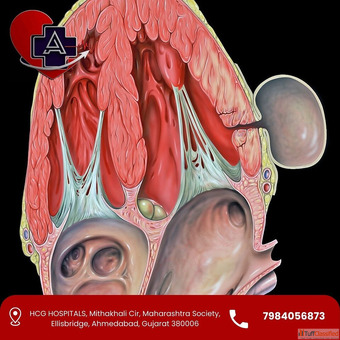 Left Ventricular Aneurysm Treatment in Ahmedabad Dr. Abhishek Parmar