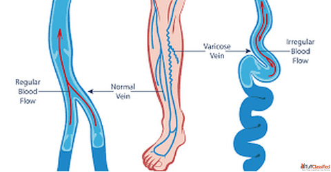 Best Varicose Veins Doctor for Advanced Minimally Invasive Treatment