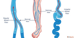Best Varicose Veins Doctor for Advanced Minimally Invasive T...
