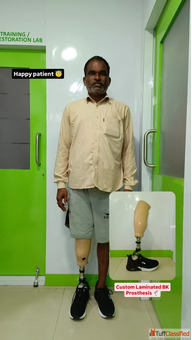 Free Artificial leg In Hyderabad CareVale Prosthetics