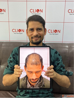 Best Hair Transplant Surgery Center Ahmedabad India