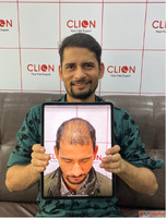 Best Hair Transplant Surgery Center Ahmedabad India
