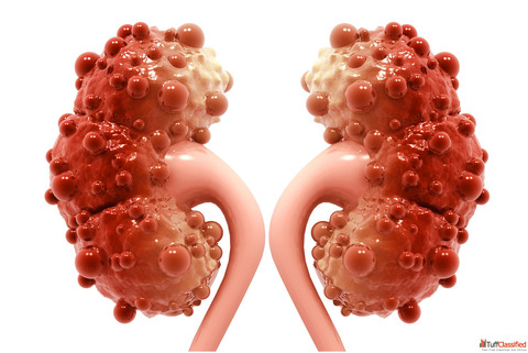 Homeopathic Care for Dangerous Kidney Cysts Symptoms Solutions