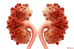 Homeopathic Care for Dangerous Kidney Cysts Symptoms Solutio...