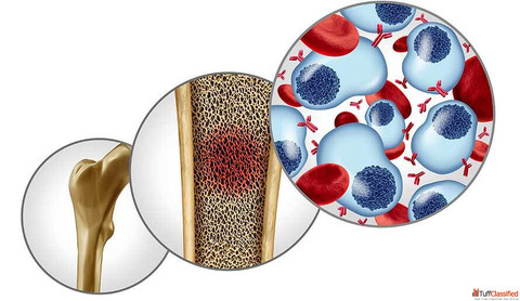 Bone Marrow Transplant for Multiple Myeloma in India