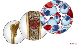 Bone Marrow Transplant for Multiple Myeloma in India