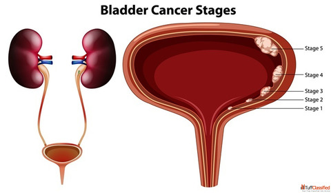 Effective Bladder Cancer Treatment in Homeopathy with Natural Remedies