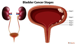 Effective Bladder Cancer Treatment in Homeopathy with Natura...