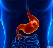 Natural Homeopathic Medicine for Gastric Ulcer for Lasting R...