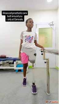 Best Artificial Leg in Hyderabad CareVale Prosthetics