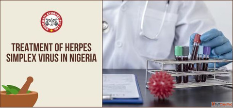 Treatment of Herpes Simplex Virus in Nigeria