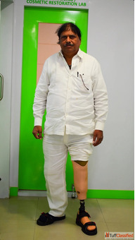 Best Artificial Leg in Hyderabad CareVale Prosthetics