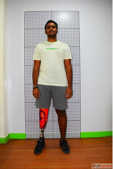 Best Artificial Leg in Hyderabad CareVale Prosthetics