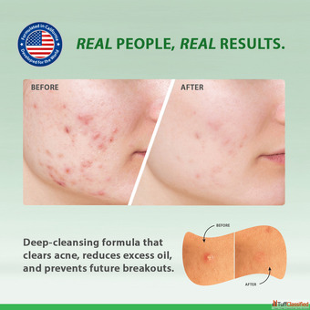 Niacinamide Stabilizing Skin During "Intermittent Fasting"