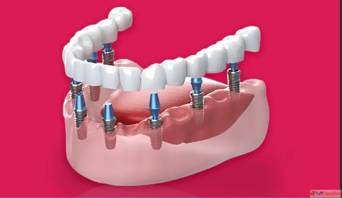 Dental Implant in Gurgaon - Easy Way to Fix Missing Teeth