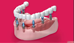 Dental Implant in Gurgaon - Easy Way to Fix Missing Teeth